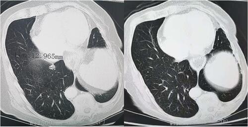 Figure 3 CT scan results of the changes for target lesions in one patient with small cell lung cancer before and after anlotinib combined with PD-1 blockade therapy.