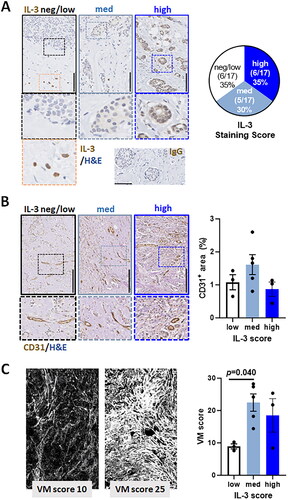 Figure 5. Human IDC sections, IL-3 staining intensity and tumor vasculature.(A) Representative IHC analysis of IL-3 protein expression by human IDC tumor tissue scored as blinded samples within an arbitrary 0–3 for negative-high DAB stain (brown) intensity with hematoxylin counterstain (blue). Black scale bar = 250µm. Right pie chart is the cumulative % scores for the neg/low, medium and high staining intensity of the 17 patient samples. Orange framed insert shows IL-3-positive T cells and bottom right is the isotype control staining. (B) Representative IHC analysis of CD31 staining of tumor vasculature in the aforementioned human IDC tumor samples previously scored 0-3 for negative-high IL-3 expression. Black scale bar = 250µm. The bar graph shows ImageJ quantified % CD31+ area detected across the 11 patient samples and grouped for IL-3 expression levels (white bar = neg/low (n = 3); light blue bar = medium (n = 5) and dark blue bar = high IL-3 (n = 3)). High magnification images illustrate CD31+ endothelial cells. (C) Representative PAS-stained fluorescence images of the aforementioned human IDC tumor samples previously scored 0–3 for negative-high IL-3 expression. The bar graph shows ImageJ quantified mean VM score for n = 11 patient samples grouped for IL-3 expression levels (white bar = neg/low (n = 3); light blue bar = medium (n = 5) and dark blue bar = high IL-3 (n = 3)). Statistical analysis using one way ANOVA with multiple comparisons, p < 0.05 considered significant.