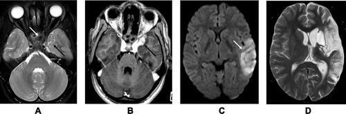 Figure 1 Angioinvasive aspergillosis in a 20-year-old female with headache and acute onset aphasia. (A) T2W axial section shows inflammatory changes in the sphenoid sinus (white arrow) with altered signal intensity in the adjacent medial aspect of the left temporal lobe (black arrow). (B) Post contrast T1W axial section shows enhancing area in the region of left temporal lobe signal abnormality. (C) Diffusion study shows an acute infarct in the left temporal lobe related to infective vasculitis of left middle cerebral artery (white arrow). (D) Follow up T2W axial section after 15 months shows chronic infarcts in the left MCA territory.