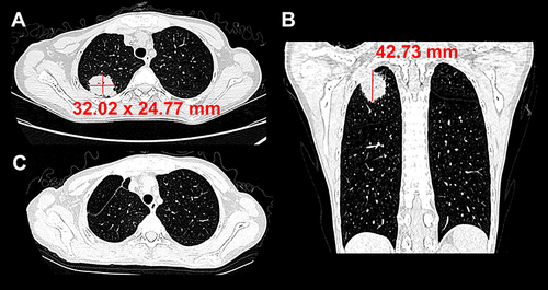 Figure 1 Chest computed tomography images of the patient before and after wedge resection of the lung lesions. Representative axial (A) and coronal (B) CT scan images revealed a large nodular lesion (32.02 mm × 24.77 mm × 42.73 mm) with a faint surrounding vitreous subpleural located in the right upper lobe. The chest CT scans show no new lung lesions 5 months after the wedge resection (C).