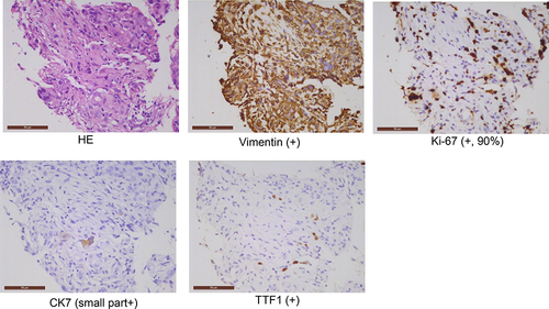 Figure 2 Hematoxylin-eosin (HE) and immunohistochemistry staining on the biopsy sample of the right parietal pleura. The rulers in Figure 2 indicate 50 μm.