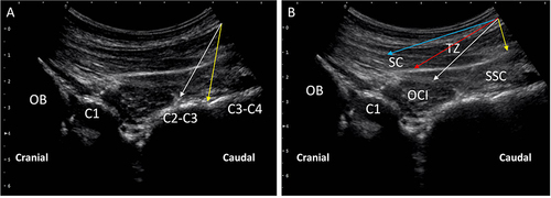 Figure 3 Ultrasound image for the TON block, C3 deep medial branch block and interfascial plane(IFP) blocks of upper cervical muscles. (A) Ultrasound image for the TON (White arrow) block and C3 deep medial branch block (Yellow arrow). (B) Ultrasound images for IFP blocks between the OCI and SSC (White arrow), the SSC and TZ (Yellow arrow), the SSC and SC (Red arrow), the SC and TZ (Blue arrow). OB, Occipital bone; C1, the posterior arch of atlas; C2-C3, C2-3 facet joint; C3-C4, C3-4 facet joint; OCI, Obliquus capitis inferior muscle; SSC, Semispinalis capitis muscle; SC, Splenius capitis muscle; TZ, trapezius muscle.