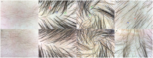 Figure 3. Pretreatment trichoscopy findings (A–D). (A): frontal angle: obvious redness of the scalp with dandruff, fine and soft vellus hair, sparse distribution; (B): top of the head: marked redness of the scalp with flaking, heterogeneity of the hair shaft diameter >20%, dilated branching-like pattern of capillaries in the red circle, brown halo around the hair follicle in the blue circle, angular plugs at the follicle opening in the green circle; (C): hair spinning: flaking and white spot signs are visible on the scalp and hair distribution is sparse; green arrows indicate grey intermediate hair; (D): occipital: obvious broken hairs, short vellus hairs and white hairs can be seen, and the hairs are sparse; the blue arrow points to broken hairs, while the red arrow points to short vellus hairs. Trichoscopy findings one and a half months (E–H). (E): Frontal angle: redness of the scalp has subsided compared with before, flaking is slightly reduced, with more vellus hair than before; (F): Top of the head: reddened areas of the scalp are less red than before, flaking is reduced, and the density of the terminal hairs and other hairs has increased; (G): Hair spinning: terminal hair and hair density has increased, with more vellus hair observed; (H): Occipital: hair density has increased, the proportion of broken hair has decreased, and a large number of vellus hairs can be seen.