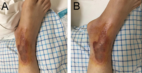 Figure 3 (A and B) Scalded right ankle.