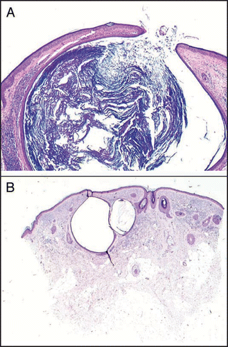 Figure 8 Hematoxylin-eosin 4x; (A) patient A, 30-year-old: open comedone; presence of inflammatory infiltrate and absence of elastosis; (B) patient B, 36-year-old: closed comedone, scarce inflammatory infiltrate and considerable elastosis.