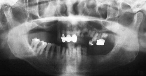 Figure 5 Pretreatment orthopantogram.