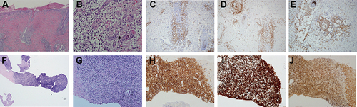 Figure 2 Skin biopsy showing diffuse infiltration of the dermis and superficial subcuits by dense lymphoid cells with perivascular and periadnexal patterns (Hematoxylineosin magnifications, (A) ×40, (B) ×400). Tumor cells were positive for CD3 (C), TdT (D), CD4 (E). Biopsy of mediastinal mass showing the tumor cells were infiltrated and most of the tumors were necrotic.(Hematoxylineosin magnifications, (F) ×40, (G) ×400) Positive staining of tumor infiltrate for CD3 (H), TdT (I), CD4 (J).