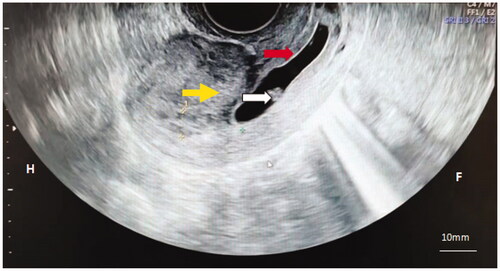 Figure 1. A representative ultrasound image of cervical pregnancy. The red arrow is showing a gestational sac, and the white arrow is showing off the germ. The gestation is located in the cervical canal, but the uterine cavity was empty (yellow arrow).