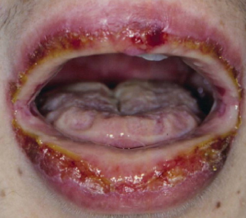 Figure 4. Hemorrhagic erosions of lips and oral cavity in erythema multiforme majus, Stevens–Johnson syndrome and toxic epidermal necrolysis.