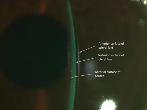 Figure 1 Midday fogging caused by fine particulate in a patient with keratoconus. In this image, the post-lens tear reservoir, between the scleral lens and the ocular surface, appears green due to the influx of sodium fluorescein after a fluorescein inflow test revealed the presence of tear exchange. This fine particulate normally appears white when examined by biomicroscopy without fluorescein.