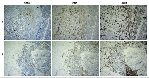Figure 2. Distribution of CD70, FAP and αSMA expression on CRC specimens. Representative IHC pictures of CD70, FAP and αSMA expression on serial cuts of one tissue sample from 2 different patients. Magnitude is 40x.
