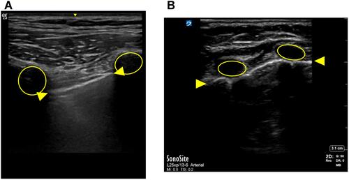 Figure 1 Demonstration of the Bat sign in an adult patient (A) and an infant (B). The Bat sign is the most basic view of lung ultrasound. The ribs are identified as low echoic regions (circles) with an acoustic shadow. The pleural line (between arrows) is a high echogenic (white) line just below and between the two ribs. Above the pleural line is subcutaneous tissue. All of the findings below the pleural line are artifact.