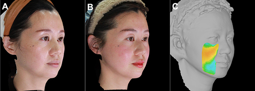 Figure 9 A 40-year-old female presenting sagging jowl fat, flat malar mound, and prominent midcheek grooves underwent the two-step fat repositioning procedure. (A) Preoperative 3D photograph; (B) 6 months post-operative photograph; (C) 3-dimensional color map of the mid-cheek and jowl regions representing volume change at 6 months.