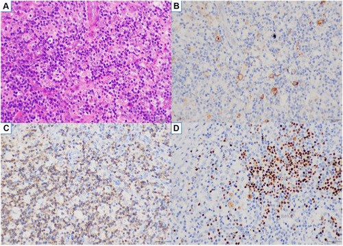 Figure 3 NSHL-related pathological results (A–D). (A) A background of complex inflammatory cells scattered with heterogeneous Hodgkin-like large cells. (B) CD30(+). (C) CD3(-). (D) PAX5(±) (all magnification times are x400).