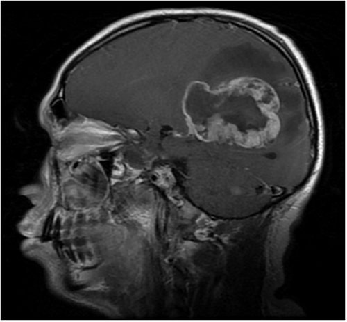 Figure 5 Male (43 years old) with headache and dizziness for six months. T1WI enhancement showing tumors exhibiting irregular ring enhancement, some with thicker walls and wall nodules.