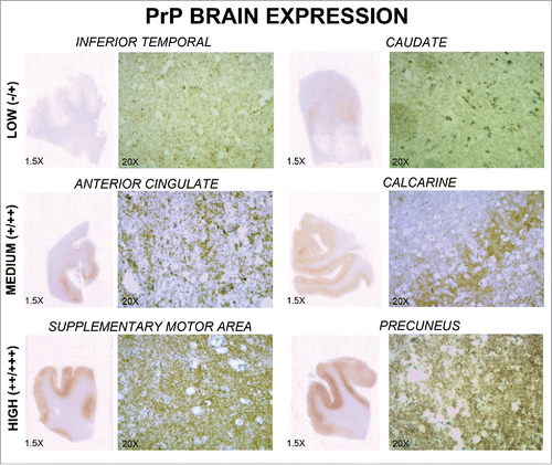 FIGURE 4. Pathological prion protein expression in several brain regions. Immunoreactivity of pathological prion protein in 6 regions (inferior temporal, caudate, anterior cingulate, calcarine, supplementary motor area, and precuneus) is shown. Each region is observed at 1.5x and 20x magnification. Different levels of expression (low, medium, and high) may be observed.