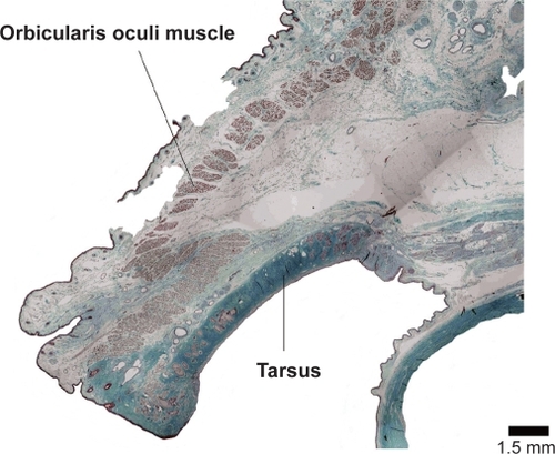 Figure 3 The preseptal orbicularis oculi muscle of the upper eyelid overrides over the pretarsal orbicularis oculi muscle. Bar = 1.5 mm.