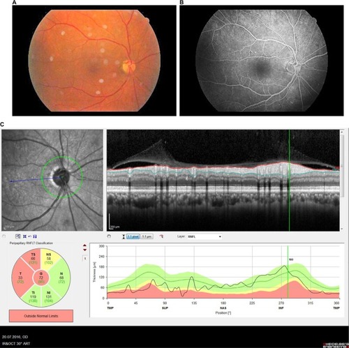 Figure 4 Retinal images 3 months after the injection.