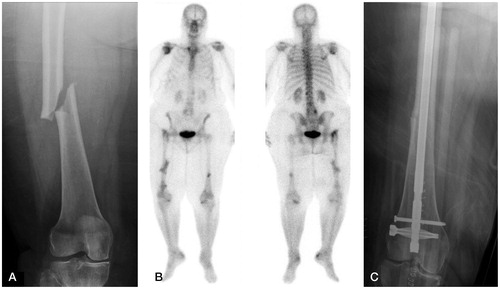 Figure 1. Patient 1. A. The right femur; initial atypical fracture. B. Bone scan imaging obtained to evaluate the presence of metastatic disease, demonstrating increased uptake in the left distal diaphysis of the femur. This uptake indicated stress changes within the bone prior to the completed atypical femoral fracture. C. Retrograde intramedullary nail fixation.