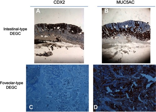 Figure 1 IHC patterns in type of differentiated EGCs (A and B) intestinal – type CDX2+ MUC5AC – (×20) (C and D) gastric – type CDX2 - MUC5AC+ (×100).Abbreviations: DEGC, differentiated EGC; EGC, early gastric cancer; IHC, immunohistochemistry.