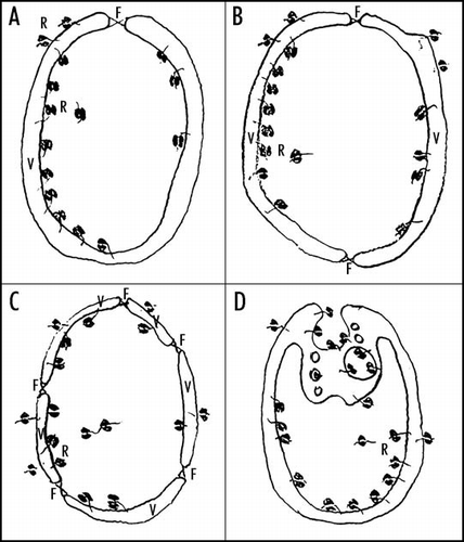 Figure 2 The hypothetical scenarios for the origin of two-membrane-bounded LUCA. (A) The fusion occurring at the orifice of a single gastruloid membrane vesicle. (B) The fusion of two cup-shaped membrane vesicles. (C) The fusion of more membrane vesicles. (D) Vesicular budding analogous to endocytic invagination. Abbreviations: V, membrane vesicle; F, the place of fusion; R, ribosomes.