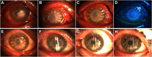 Figure 5 Successful graft transplantation in the infectious central corneal ulcer group. (A–D) Before surgery (A) and at 1 day (B), 7 days (C and, D), 1 month (E), 3 months (F), 6 months (G), and 12 months (H) postoperatively.