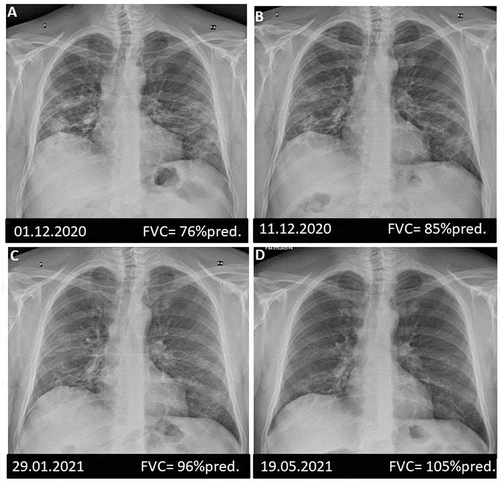 Figure 3. Chest X-ray and spirometric measurements of the 45-year-old patient after COVID-pneumonia during a continued steroid treatment: A – baseline, B – after 10 days, C – after 1,5 month, D – after 5 months. FVC, forced vital volume.
