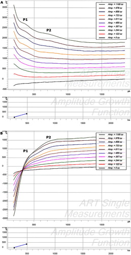 Figure 2 Raw data of ECAP recordings prior to any artifact reduction with an offset of 200 cu for visualization purposes. Although masked by the stimulation artifact, the double peaks (P1 and P2) are still visible. (A) AC (biphasic stimulation, anodic first – cathodic second). (B) CA (cathodic–anodic).