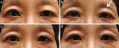 Figure 1. A case of DUES caused by treatment with benzalkonium chloride (BAK)-preserved tafluprost ophthalmic solution.