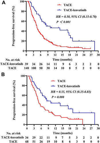 Figure 2 (A) Kaplan–Meier survival curves for progression-free survival before PSM. (B) Kaplan–Meier survival curves for progression-free survival after PSM.