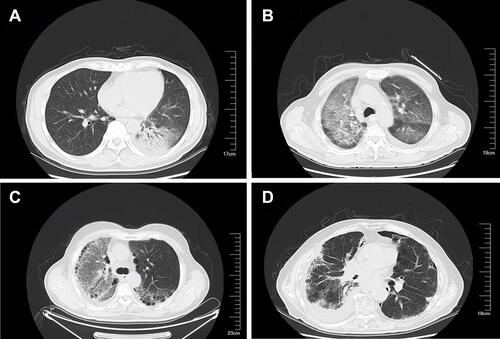 Figure 2 (A) The lower left lung consolidation using an air bronchogram. (B) Ground-glass opacity and mesh opacity of the right lung and the left lung. (C) Ground-glass bilateral lung opacity, with left pleural effusion. (D) Ground-glass opacity, mesh opacity, and pleural effusion of the right lung.