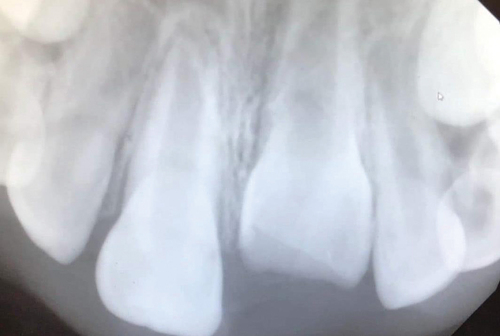 Figure 3. Appointment 1 radiograph.