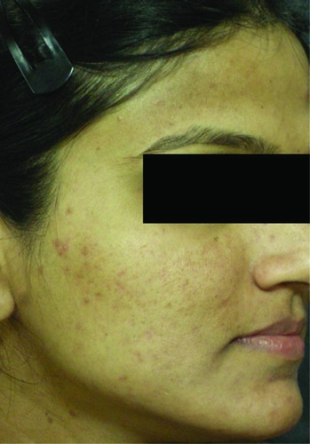 Figure 2 Post-acne scars and pigmentation after eight sessions of glycolic acid peel.