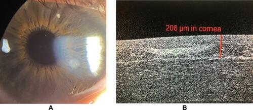 Figure 1 OCT-guided femtosecond LASIK in the setting of previous corneal scarring. (A) Pre-operative slit lamp photo of a patient with history of a traumatic corneal foreign body injury. The opacity was located in the mid-peripheral cornea and measured 1.5×1.5 mm. (B) One-day post-operative OCT corneal image of the same patient demonstrating maximum depth of the opacity at 180 microns for which the intended flap depth was aimed at 200 microns.