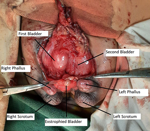 Figure 1 Intraoperative picture revealing a triplicated bladder with diphallia.