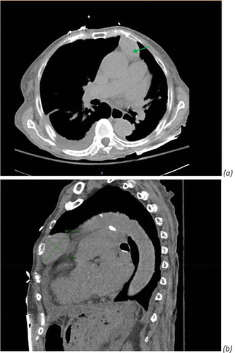 Figure 3. Computed tomography (CT) chest without contrast revealed ovoid anterior mediastinal mass consistent with thymoma. (a) Green arrow. (b) Diameter measurement of thymoma, 5.6 × 3.1 cm ovoid anterior mediastinal mass.