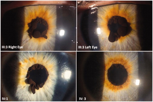 FIGURE 2. Anterior segment slit-lamp biomicroscopy of iris flocculi present in the family affected with TAAD. The iris flocculi evolve with age, increasing with age, as shown in individual III:3 (50 years old); IV:1 (30 years old) and IV:3 (25 years old). Individuals are labelled as documented in Figure 1.