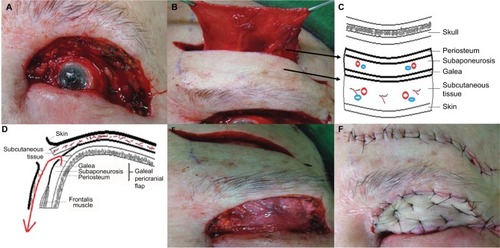 Figure 2 Surgical technique for single-staged total upper eyelid reconstruction after sebaceous gland carcinoma excision.