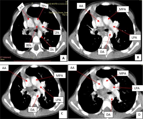Figure 3 (A–D) Sequential chest CT images demonstrating volume loss of the right hemithorax with shift of the mediastinum toward the right.