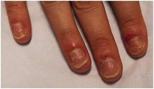 Figure 4. Nail pitting and onycholysis in right fingernails.