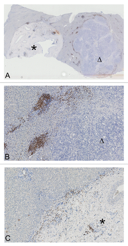 Figure 6. (A) Heterogeneity of synchronous hepatic metastases of colorectal carcinoma. Overview image of two synchronous hepatic metastases of colorectal carcinoma stained for CD3+ cells, showing a liver section with two round metastases (marked with an asterisk and a triangle, magnification 1.5×). (B) Magnification (10×) of the right metastatic lesion in (A) (triangle). CD3+ cell infiltrates are clearly discernible at the invasive margin and in the adjacent liver. (C) Magnification (10×) of the left metastatic lesion in (A) (asterisk). CD3+ cell infiltrates at the invasive margin are scarce, tumor cells accumulate at the same location, and the core of lesion exhibits large arterial vessels but mainly consists of stromal components.