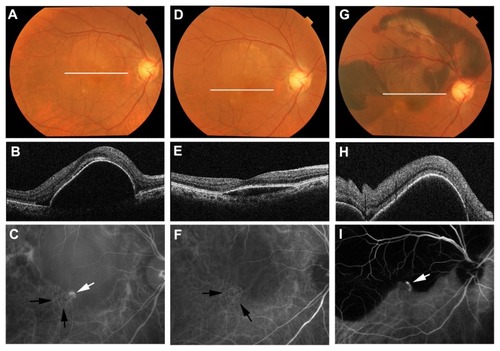 Figure 3 Right eye of a 74-year old male with subretinal hemorrhage after combined PDT and IVR treatment for PCV. White lines in each color fundus photograph (A, D and G) show the scanning line of the OCT image at each time point. Baseline OCT (B) shows retinal pigment epithelial detachment on the macula. Baseline visual acuity was 0.7. ICGA (C) shows a polypoidal lesion (white arrow) and branching vascular network (black arrows). Three months after initial treatment, the retinal pigment epithelial detachment was reduced in OCT (E). Visual acuity was improved to 0.9. In ICGA (F), the branching vascular network persisted (black arrows), despite the disappearance of polypoidal lesions. Five months after initial treatment, color fundus photography (G) and OCT (H) showed massive hemorrhagic retinal pigment epithelial detachment in the macula. Visual acuity was decreased to 0.3. ICGA (I) shows recurrence of polypoidal lesions (white arrow).