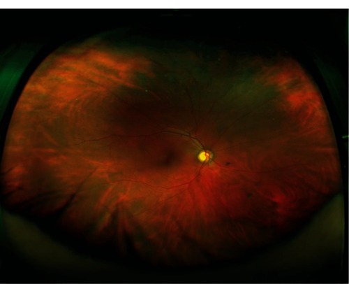 Figure 2 Color fundus photograph of an eye without white without pressure or peripheral pathology.