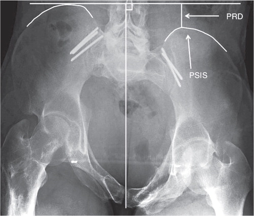 Figure 2. Measurement of posterior residual displacement (PRD) of the right hemipelvis and sacrum illustrated on a pelvic inlet image. A midline vertical line is drawn along the axis of the central portion of the sacrum. A horizontal line, perpendicular to the vertical line, is drawn on the highest of the 2 measurement points—in this case the posterior superior iliac spines (PSIS). The difference in height between the 2 PSIS is the PRD.