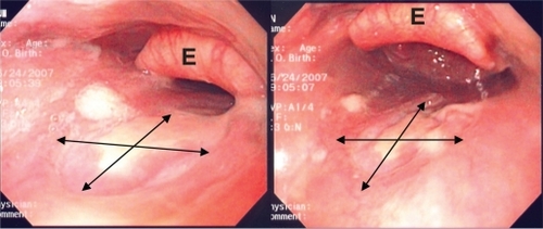 Figure 2 Endoscopic view of the oropharynx showing the 2 × 2 cm ulcer. Double-headed arrows outline the inner diameter of the ulcer. E, epiglottis.