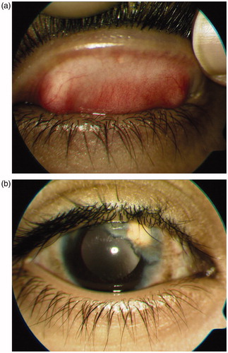 FIGURE 1. (a) Superior palpebral conjunctiva on presentation showing a diffuse, fine papillary reaction. (b) Slit-lamp photograph of the right eye showing corneal neovascularization and associated lipid deposition.