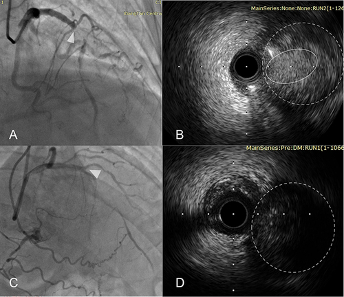 Figure 2 Intravascular ultrasound image of microchannel at proximal stump: (A) A left anterior descending artery was totally occluded. A 40-MHz IVUS catheter (Opticrosstm, Boston Scientific, America) pullback from the side branch identifies the ostium of the CTO (white arrow). (B) Microchannel (a low echogenicity structure, dotted circle) at the proximal stump (solid circle). (C and D) A left anterior descending totally occluded artery (white arrow) and without microchannel at the proximal stump (solid circle).