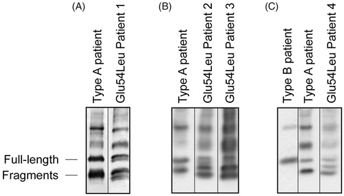 Figure 1. Western blot analysis of adipose tissue. All four of the ATTR Glu54Leu amyloidosis patients we have investigated showed a unique western blot pattern of TTR.