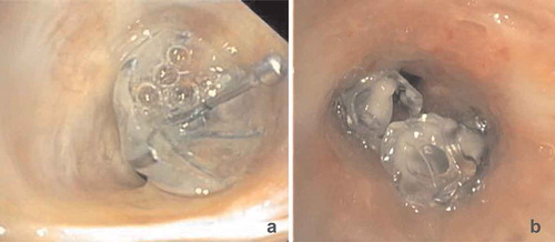 Figure 5. Loss of effect due to valve dislocation which causes leakage along the Spiration Valve System (a) and Endobronchial Valve (b)