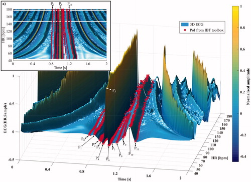 Figure 5. 3 D representation of all templates for one ECG recording overlaid with characteristic points from the IBT toolbox. As one can observe from the graph, the detectable points correlate with the minima and maxima (valleys and mountains). This depiction is referred to as 3 D ECG. (a) Top view for better legibility. HR: Heart rate.